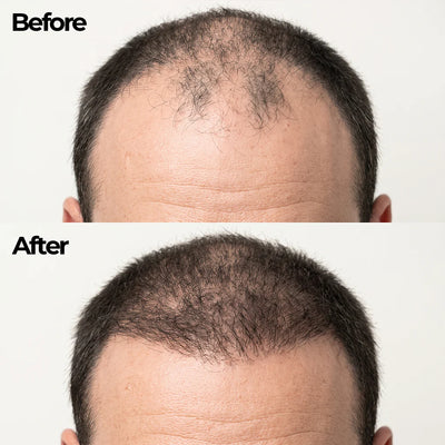 Korean Hair Growth Bar for Men