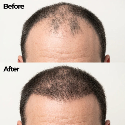 Korean Hair Growth Bar for Men
