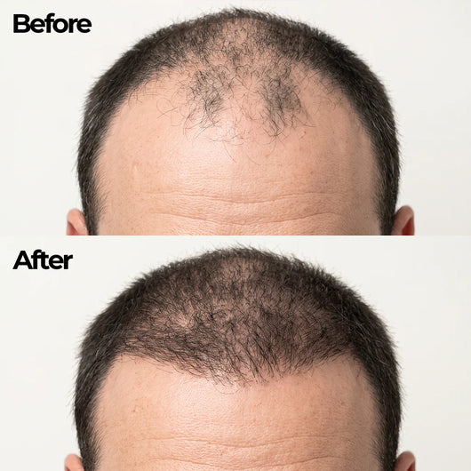 Korean Hair Growth Bar for Men
