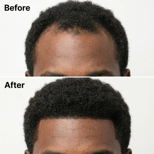 Korean Hair Growth Bar For Men